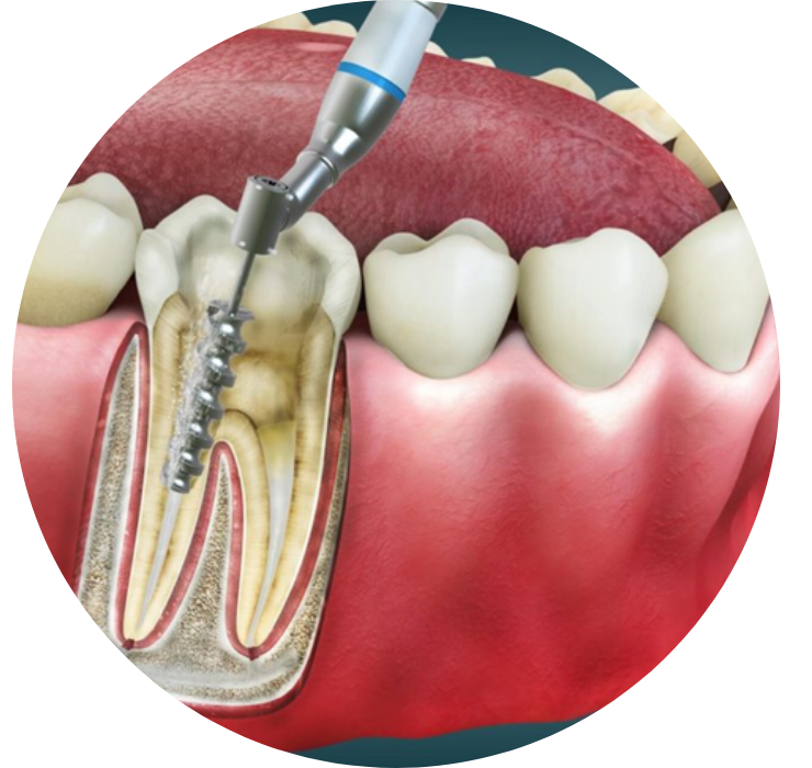 Root Canal Treatment