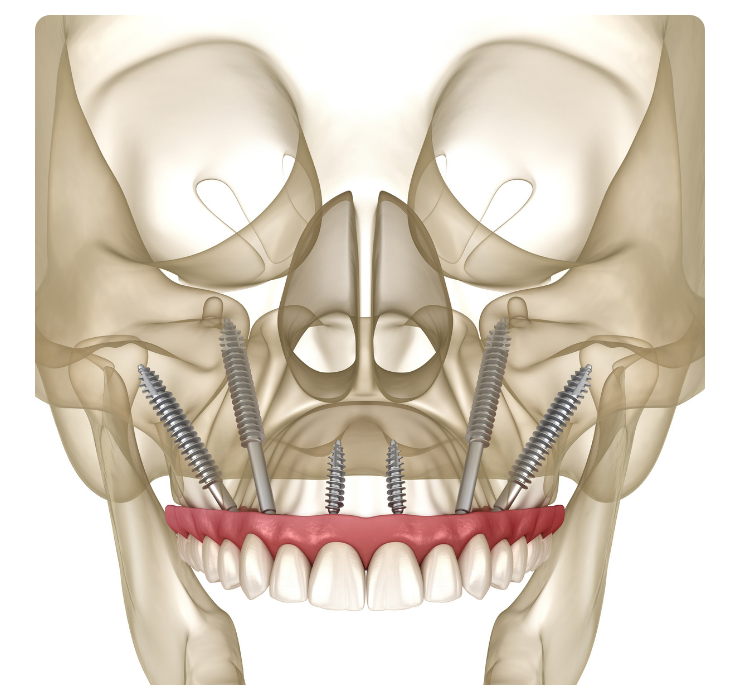 Zyogma Implants