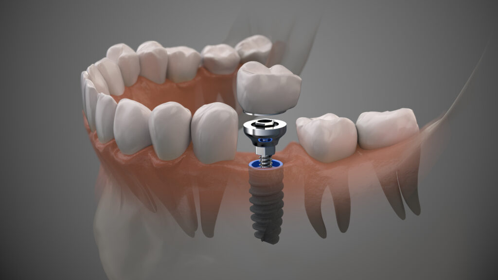 Dental Implant Final Adjustment