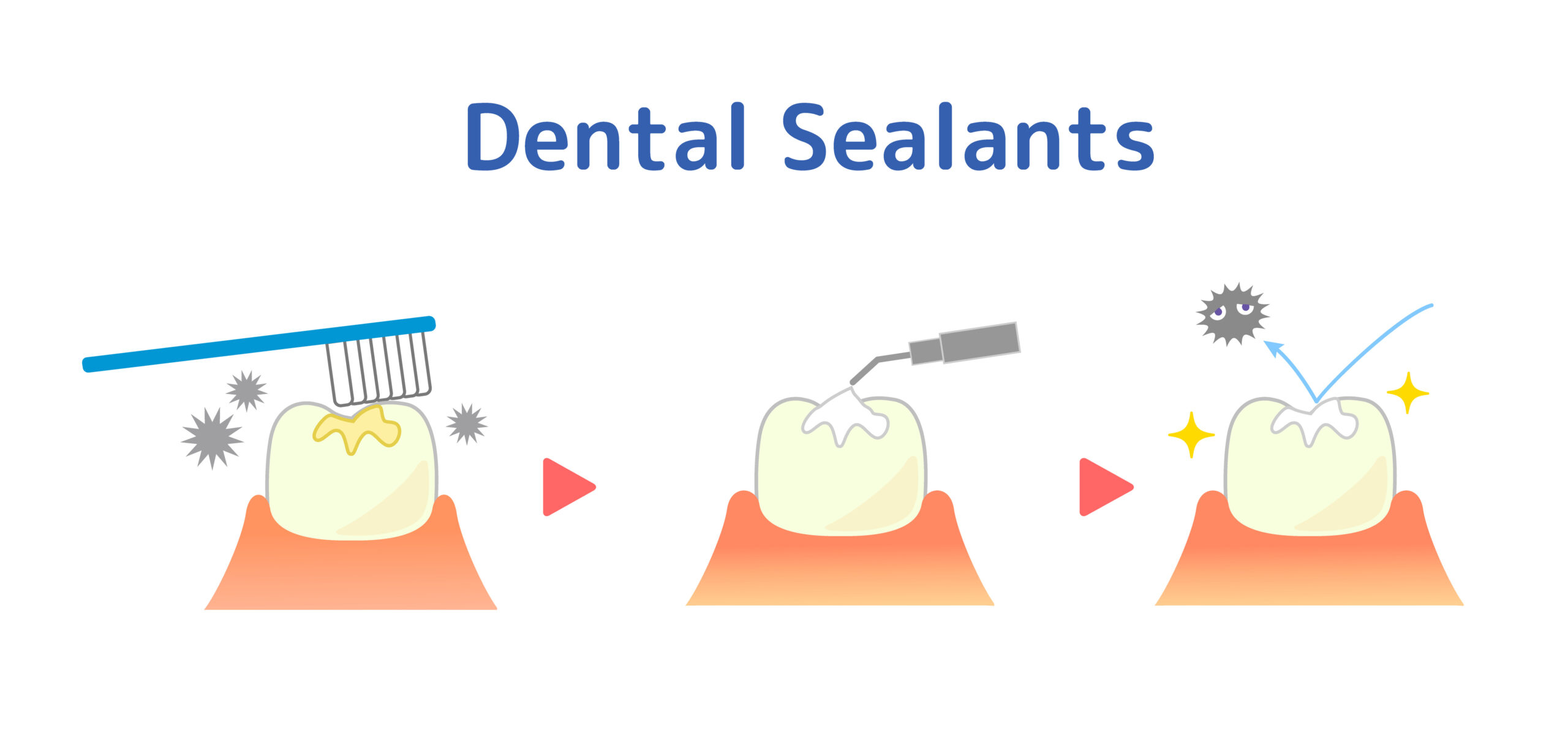 Dental Sealants