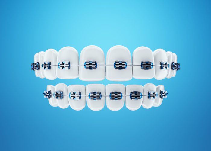 White teeth with metal braces on a blue background. Dental braces, orthodontic treatment, dentistry, teeth whitening, protection, oral care, hygiene, healthcare. 3D illustration, 3D render